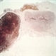 Melanoma